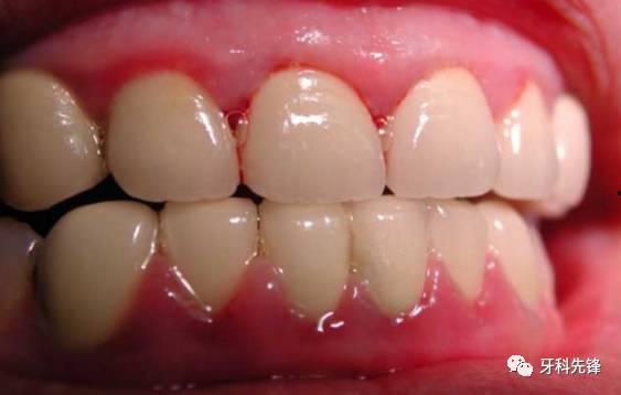 吃白瓜牙龈疼,揭秘食用白瓜的注意事项